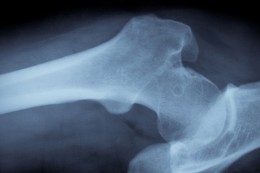 Strontium Offers Natural Osteoporosis Treatment Breakthrough