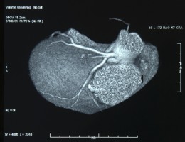 Coronary Artery Calcium Score: The Best Way To Know If You Have Early ...