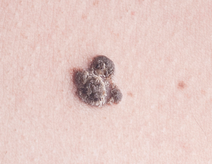 Difference Between Age Spots And Cancer Age Spots Vs Cancer