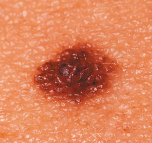age spots — non-cancerous mole