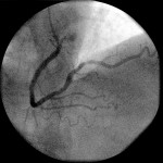 radiograph of blocked artery