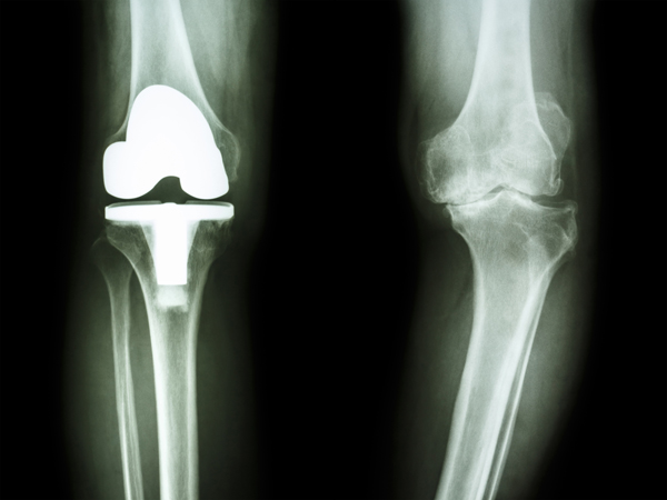 Knee Replacement Alternatives vs. Knee Surgery: Explore Your Options ...