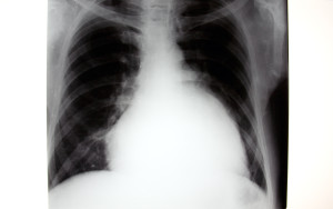 Radiograph of enlarged heart characteristic of cardiomyopathy. 