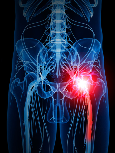 sciatic-nerve-pain-how-to-deal-with-the-effects-of-sciatica-in-your