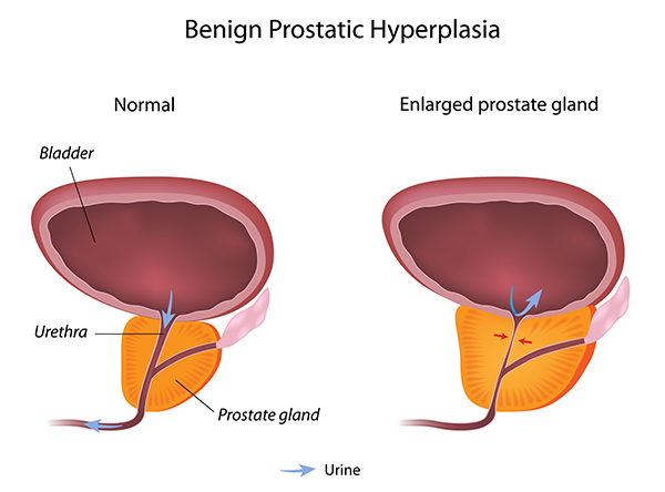 benign prostatic hyperplasia (bph) is characterized by)
