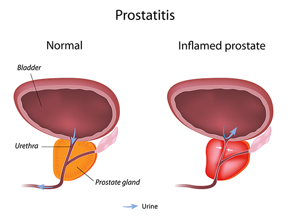 acute bacterial prostatitis pain