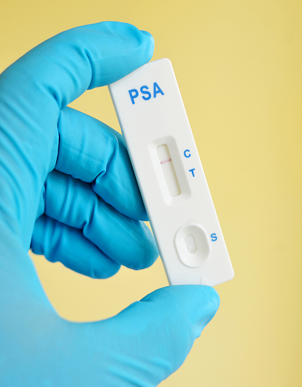 Prostate Cancer Symptoms Psa Test Is Only Part Of The Story 9502