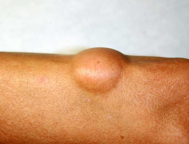 Is Skin Cancer Benign Or Malignant