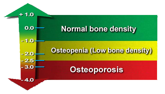 T Score Bone Density Chart: Understand Your Bone Density Scores