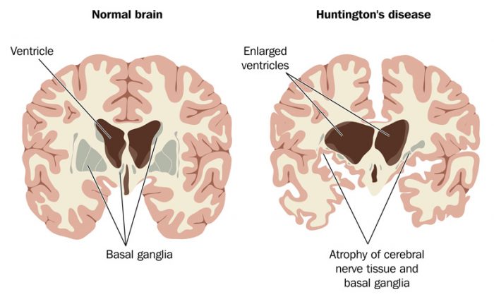 atrophy brain