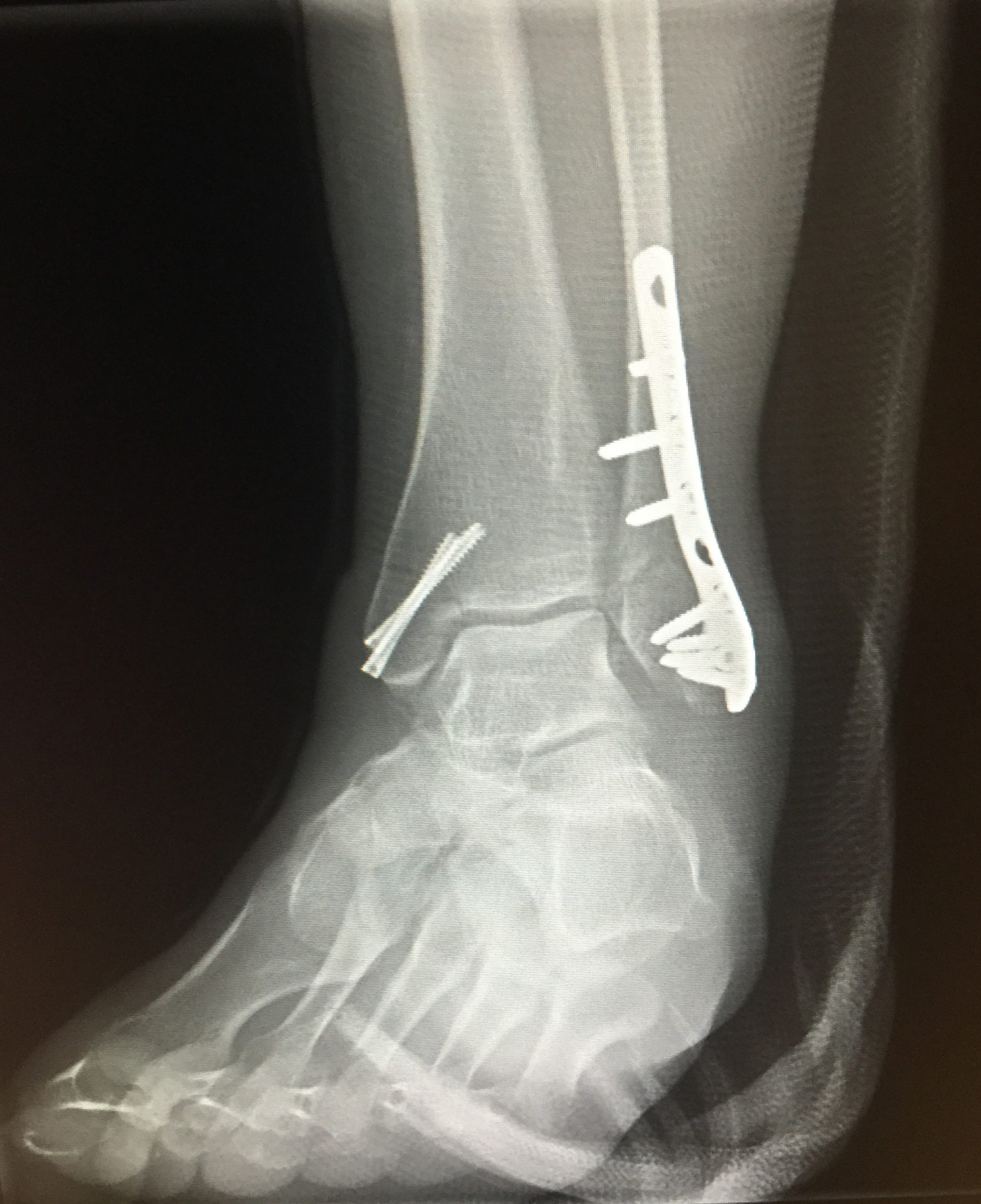 UHN Blog Emergency Coping With A Broken Ankle Overseas University 