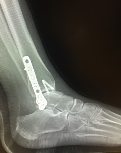 broken ankle side view
