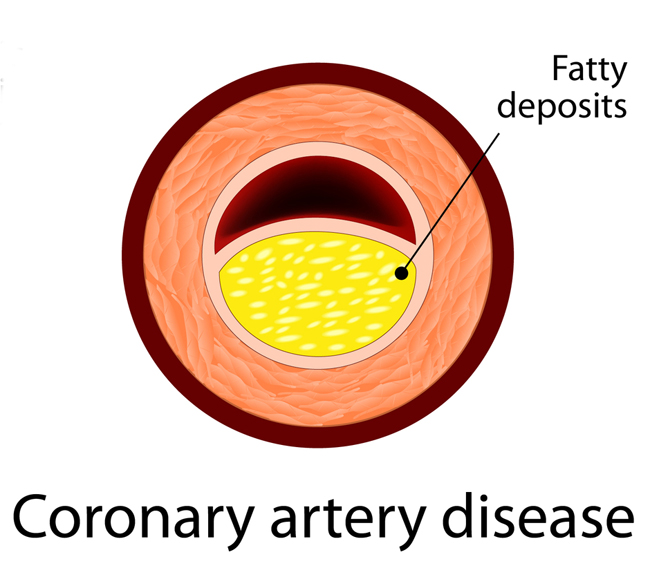 acute-coronary-syndrome-acute-coronary-syndromes-jama-jama-network