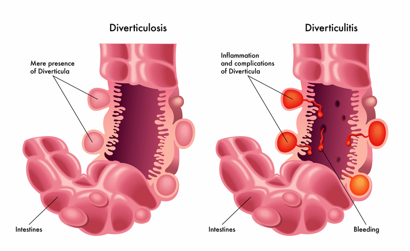 Diverticulitis prostatitis