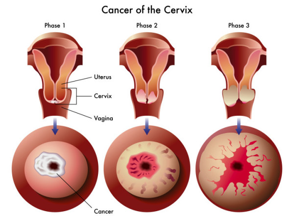 Hpv throat cancer signs and symptoms