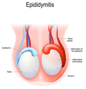 chronic or acute epididymitis 