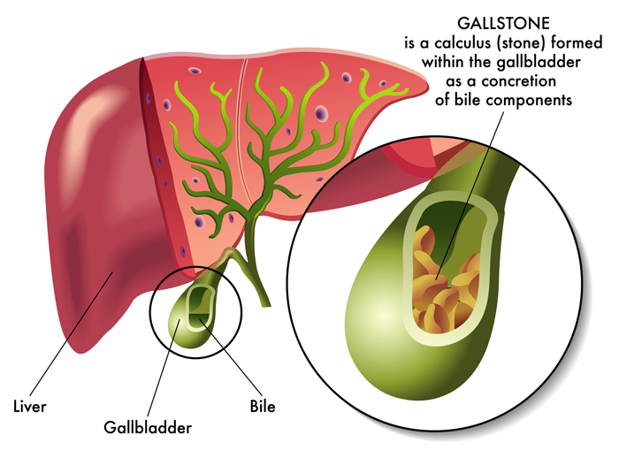 The Healthy Gallbladder Diet - University Health News