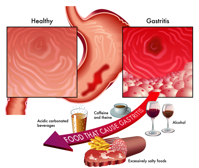 Gastritis How To Recognize Common Symptoms University Health News