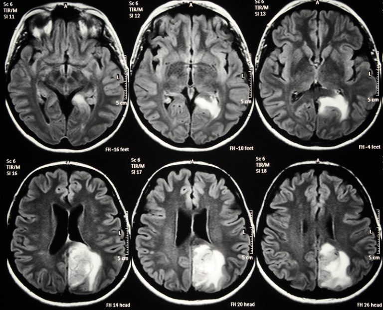 Glioblastoma Understanding an Aggressive Form of Brain Cancer