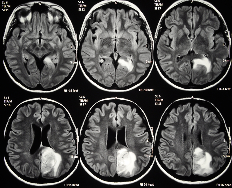 glioblastoma-understanding-an-aggressive-form-of-brain-cancer