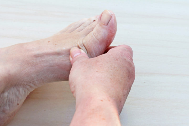 heel pain and uric acid