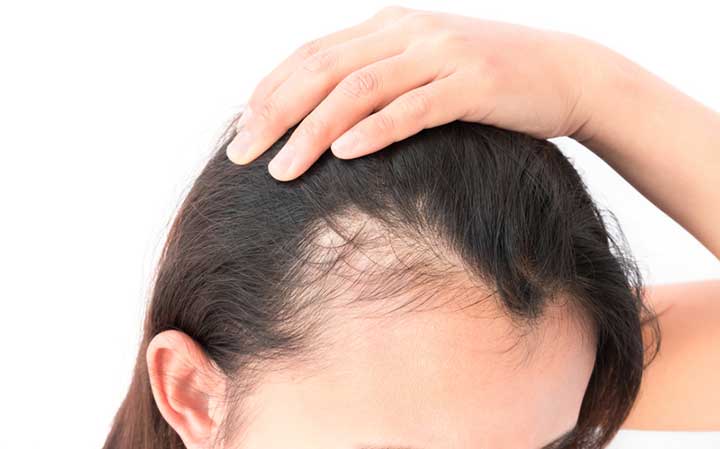 What S Causing Your Hair Loss University Health News