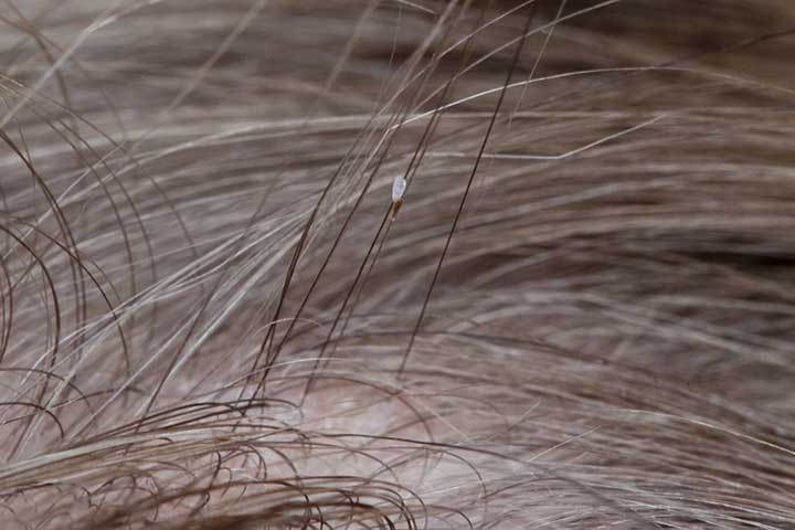 Head Lice Are Equal-Opportunity Invaders - University Health News