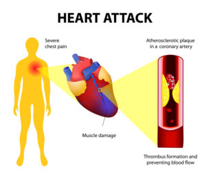 chest pain location chart