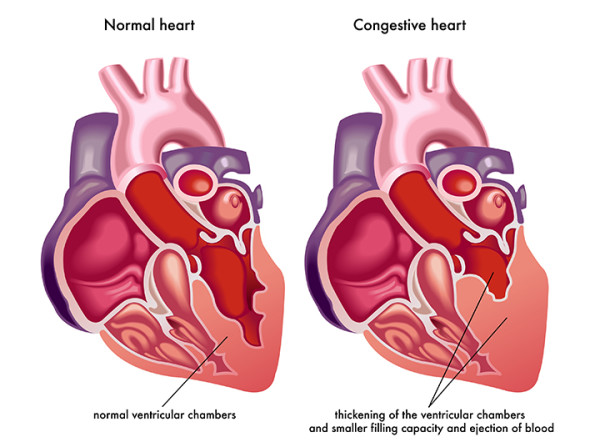 what-is-congestive-heart-failure-university-health-news