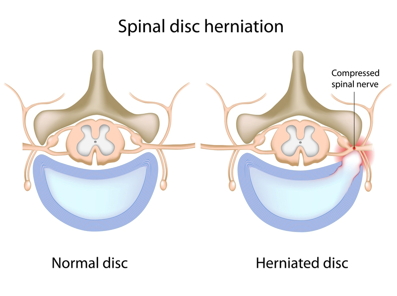 Herniated Disc or Bulging Disc Pain? Consider These ...