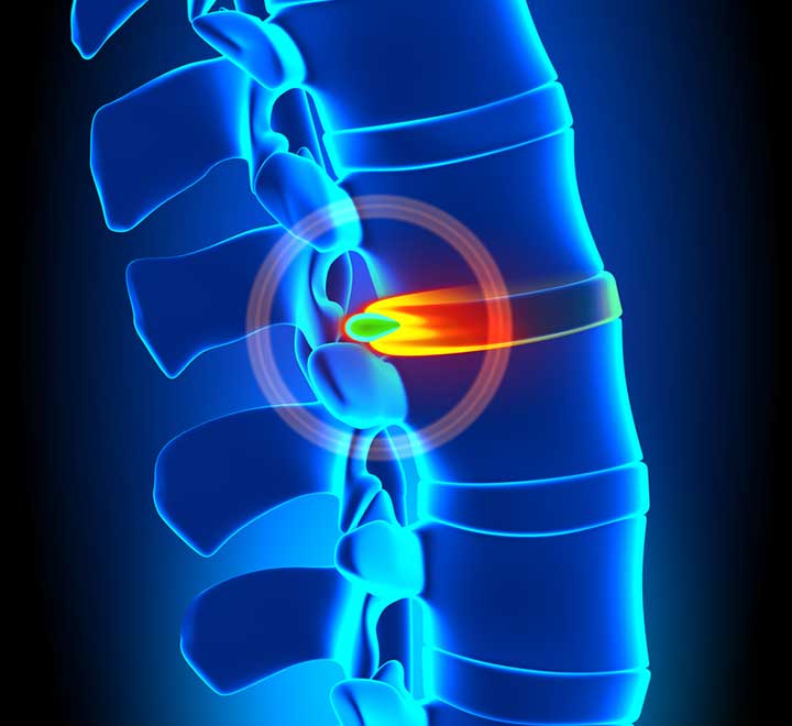 A Herniated Disc Causes Back and Leg Pain - University Health News