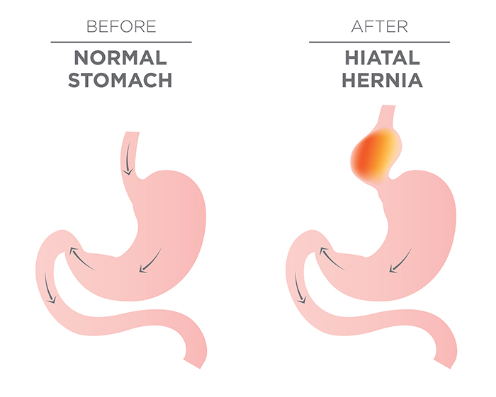 Hiatal Hernia Diet Chart