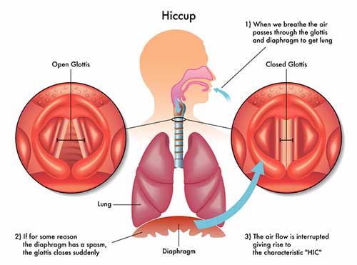 How to get rid of hiccups after anesthesia