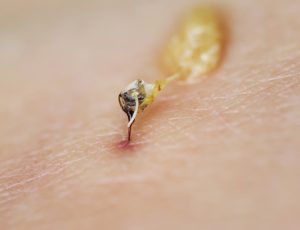 how to treat a bee sting