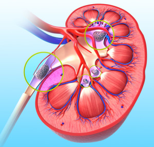 kidney stones and kidney stone pain