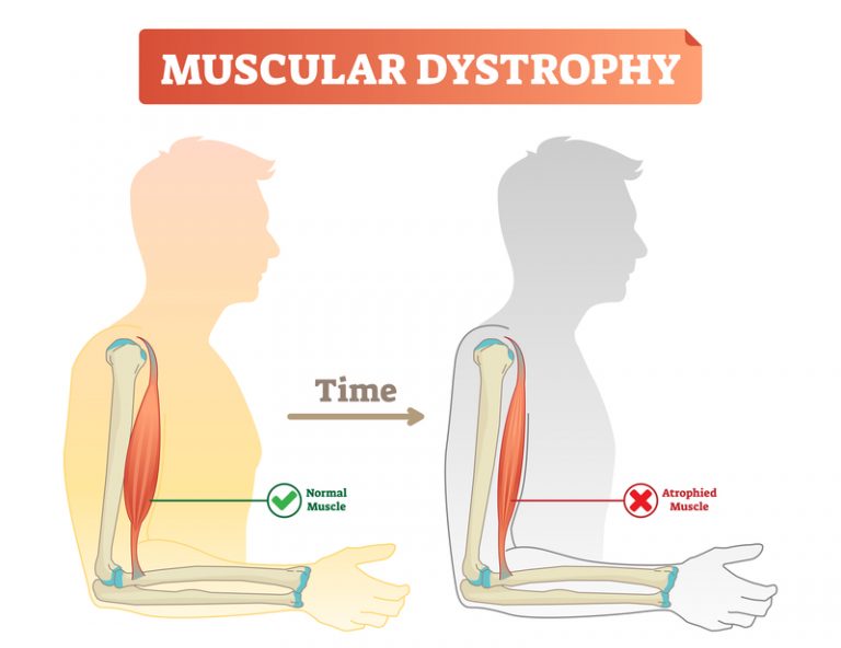 muscular-dystrophy-what-causes-this-disabling-condition-university