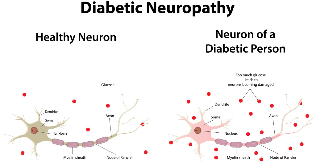 healthy and diabetic neuron
