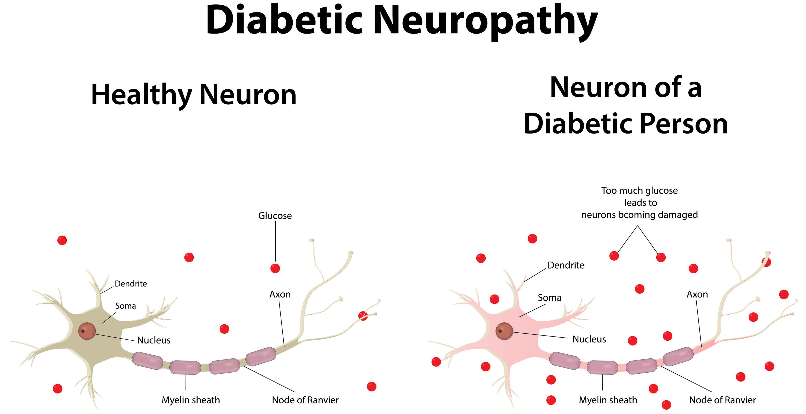 Diabetic Neuropathy: What It Means, How to Treat It - University Health ...