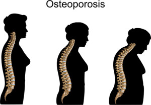 what is osteoporosis