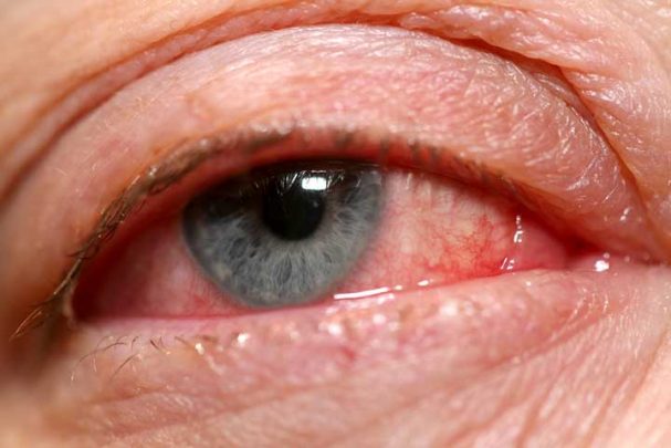 6 Ways to Avoid Pinkeye | University Health News