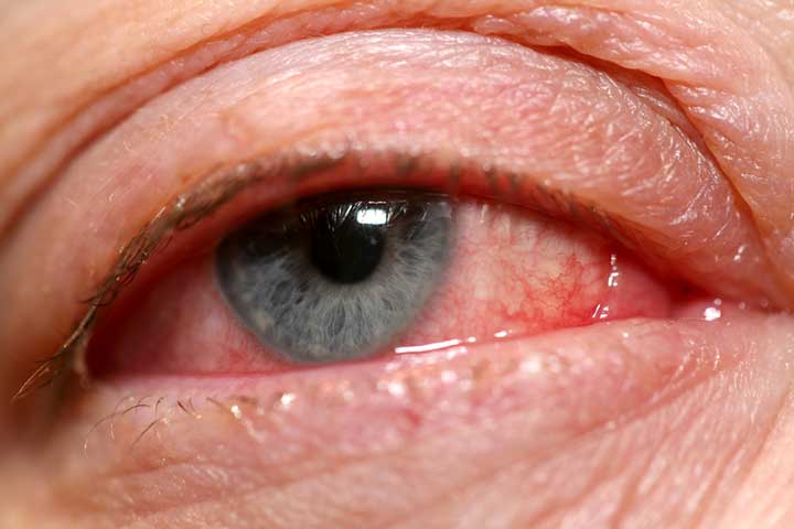 6 Ways to Avoid Pinkeye - University Health News