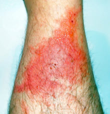 Poison Ivy: America’s Rash | University Health News