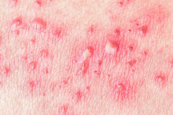 Shingles Everything You Need To Know To Treat It—or To Avoid It