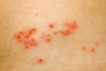 5 Common Myths About Shingles - University Health News