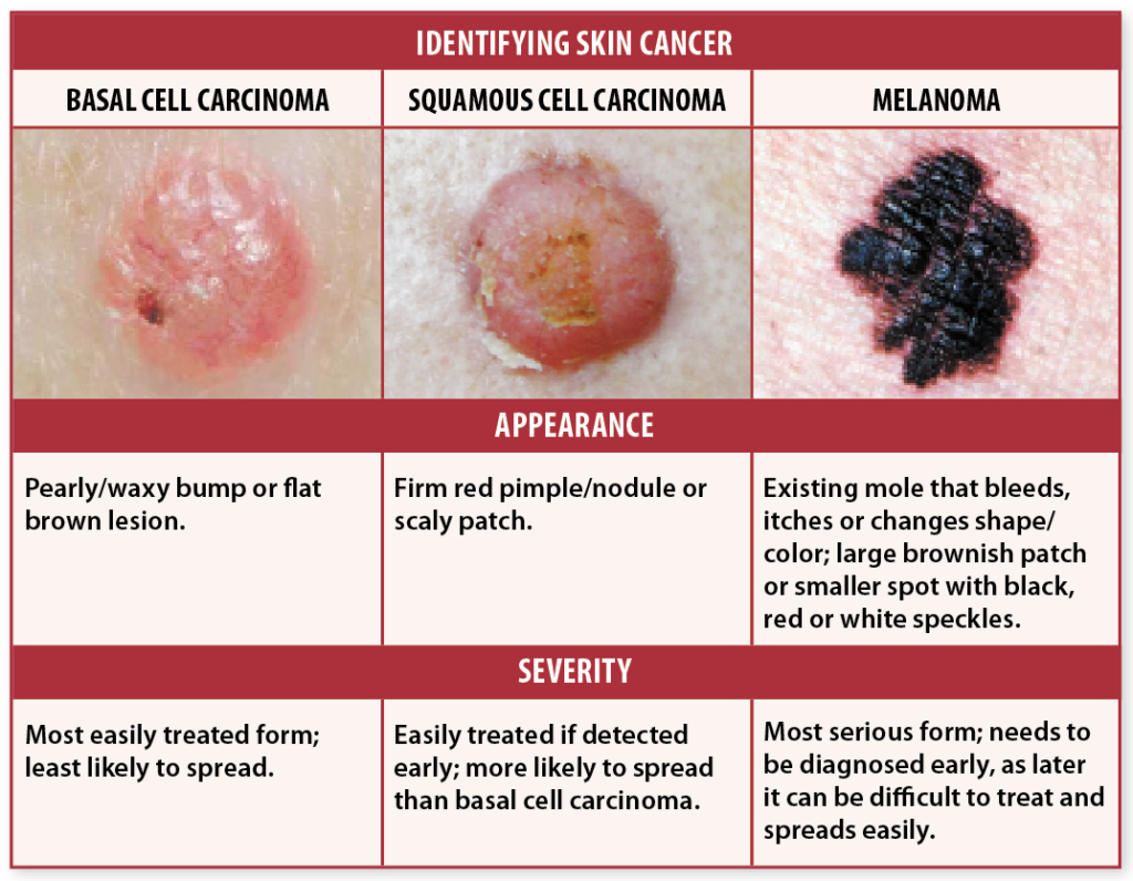 Skin Cancer Signs Self Checks May Help You Avoid Deadly Recurrence   Skin Cancer Signs Chart 1024x796 