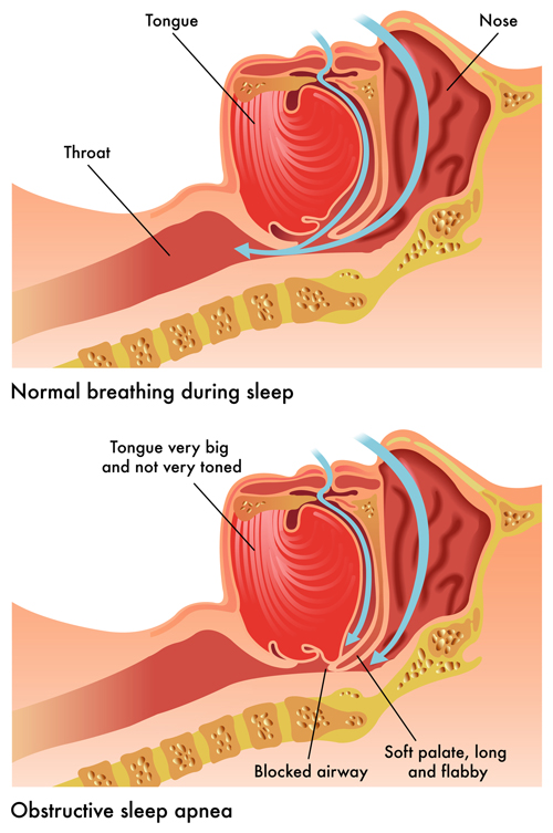 Can Obstructive Sleep Apnea Cause Insomnia