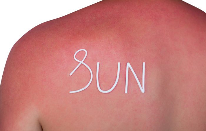 Instant Sunburn Relief 9 Ways To Soothe Your Burn University Health News