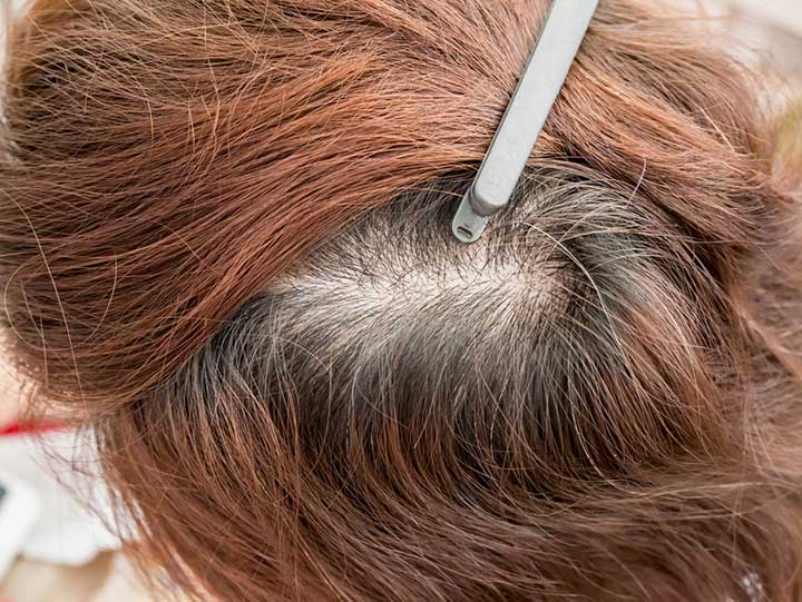 What Does Thinning Hair Indicate