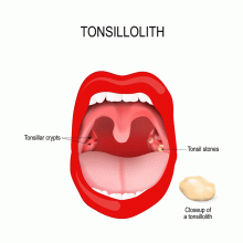 Tonsil Stones: Symptoms & Treatment | University Health News