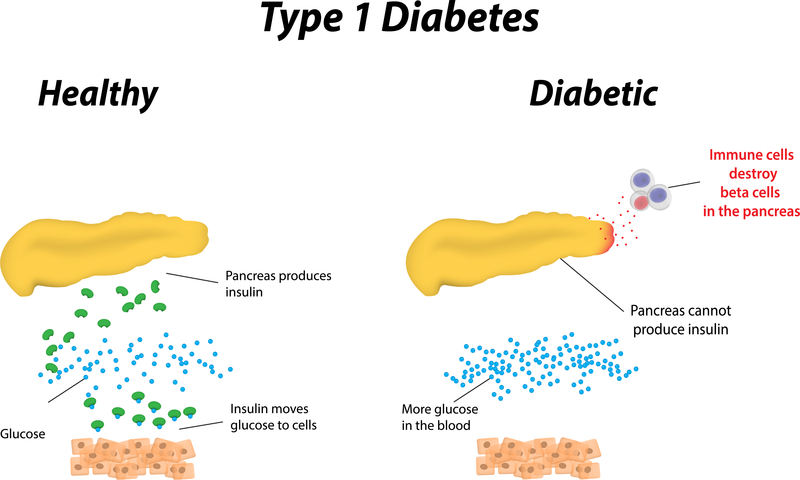 type 1 diabetes chart
